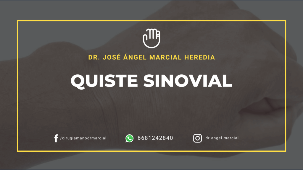 Quiste Sinovial en Los Mochis