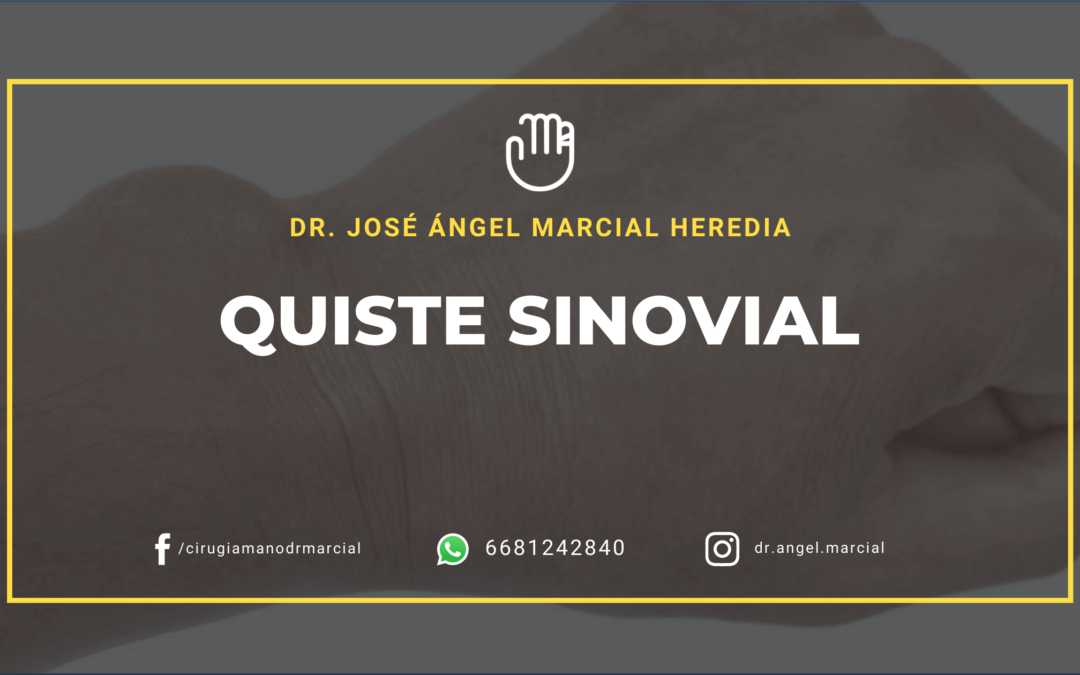 Quiste Sinovial