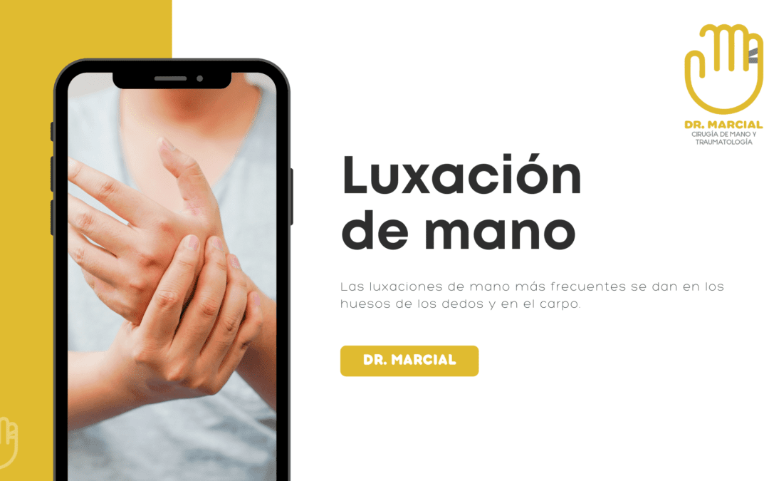 Luxación de mano